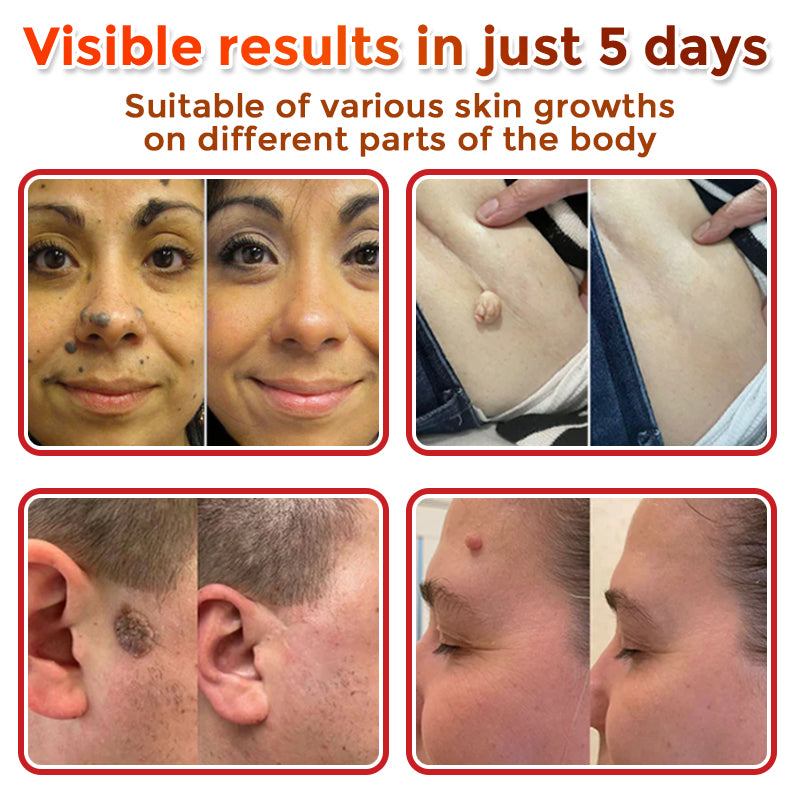 GFOUK® MicroNeedle Botanic Skin Tag Removal Patch 🇦🇺 Made in Australia