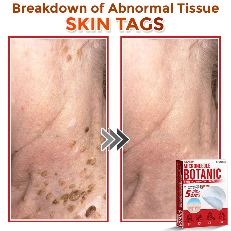GFOUK® MicroNeedle Botanic Skin Tag Removal Patch 🇦🇺 Made in Australia