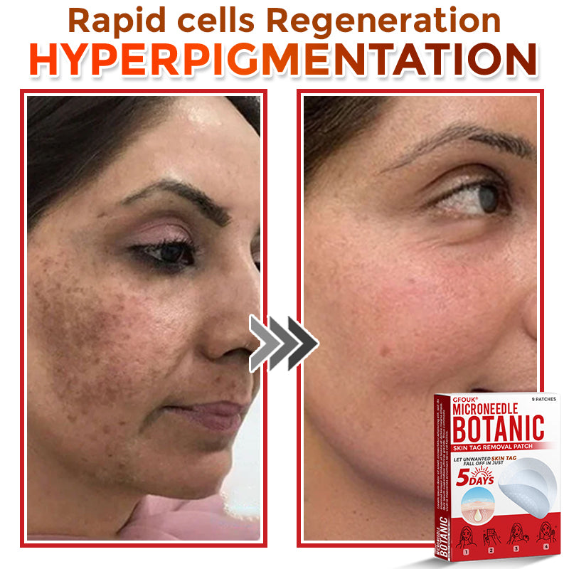 GFOUK® MicroNeedle Botanic Skin Tag Removal Patch 🇦🇺 Made in Australia