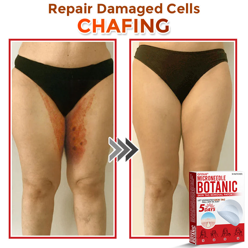 GFOUK® MicroNeedle Botanic Skin Tag Removal Patch 🇦🇺 Made in Australia