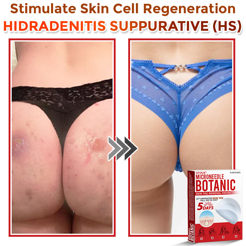 GFOUK® MicroNeedle Botanic Skin Tag Removal Patch 🇦🇺 Made in Australia