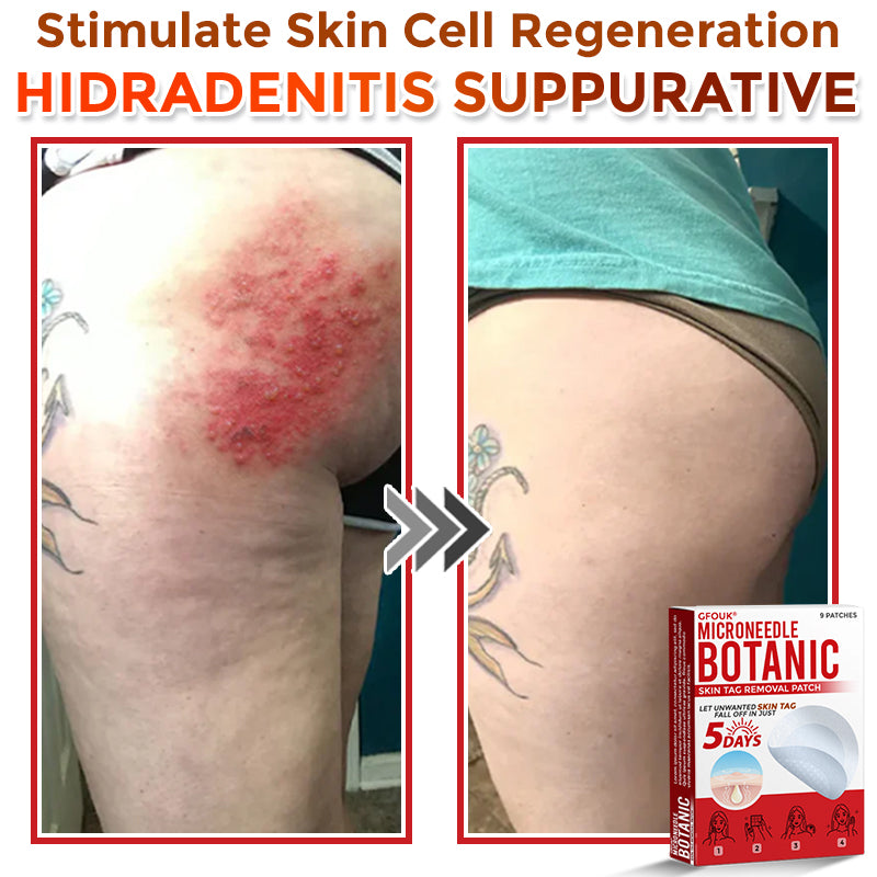 GFOUK® MicroNeedle Botanic Skin Tag Removal Patch 🇦🇺 Made in Australia