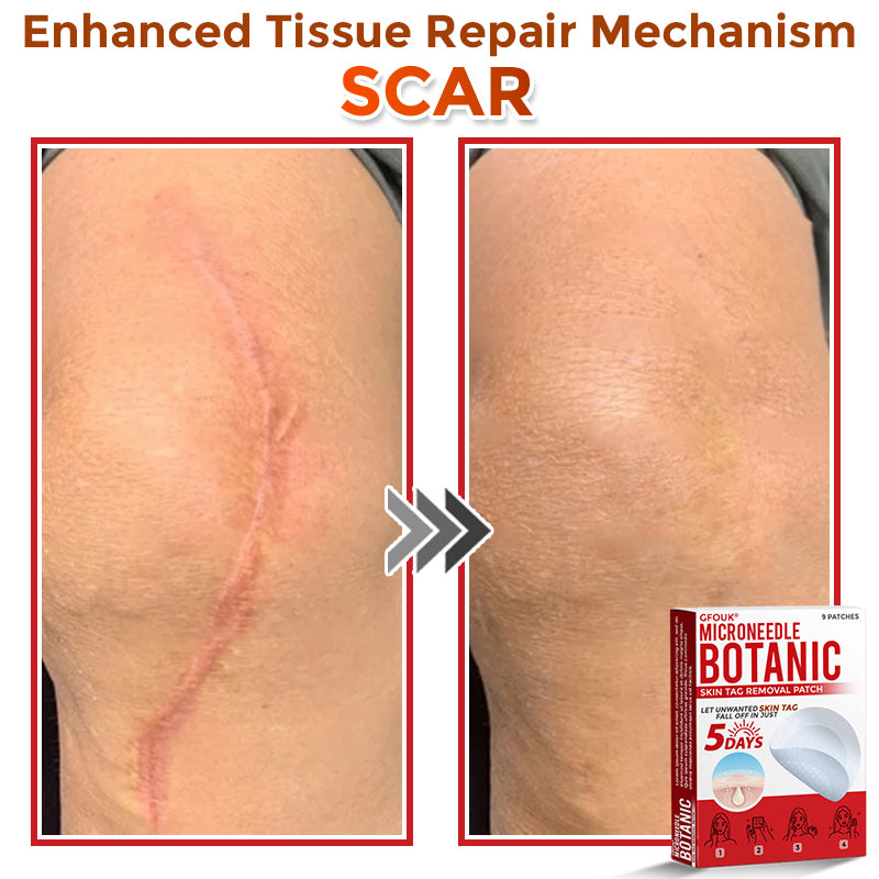 GFOUK® MicroNeedle Botanic Skin Tag Removal Patch 🇦🇺 Made in Australia