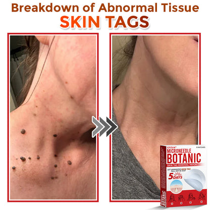 GFOUK® MicroNeedle Botanic Skin Tag Removal Patch 🇦🇺 Made in Australia
