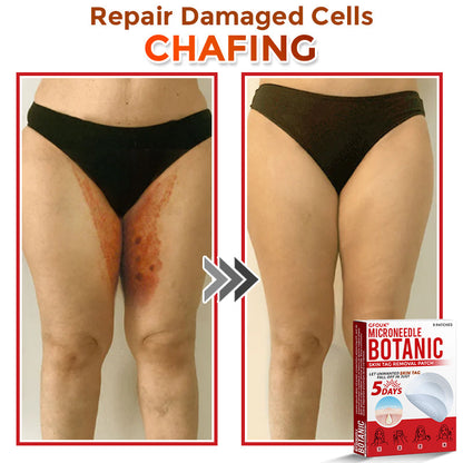 GFOUK® MicroNeedle Botanic Skin Tag Removal Patch 🇦🇺 Made in Australia
