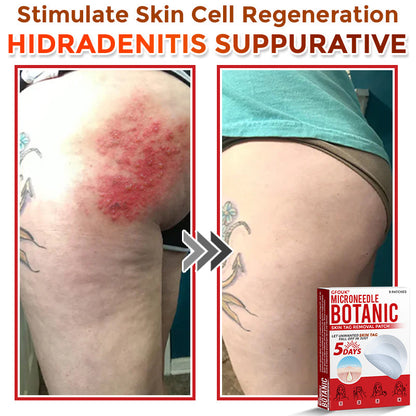 GFOUK® MicroNeedle Botanic Skin Tag Removal Patch 🇦🇺 Made in Australia